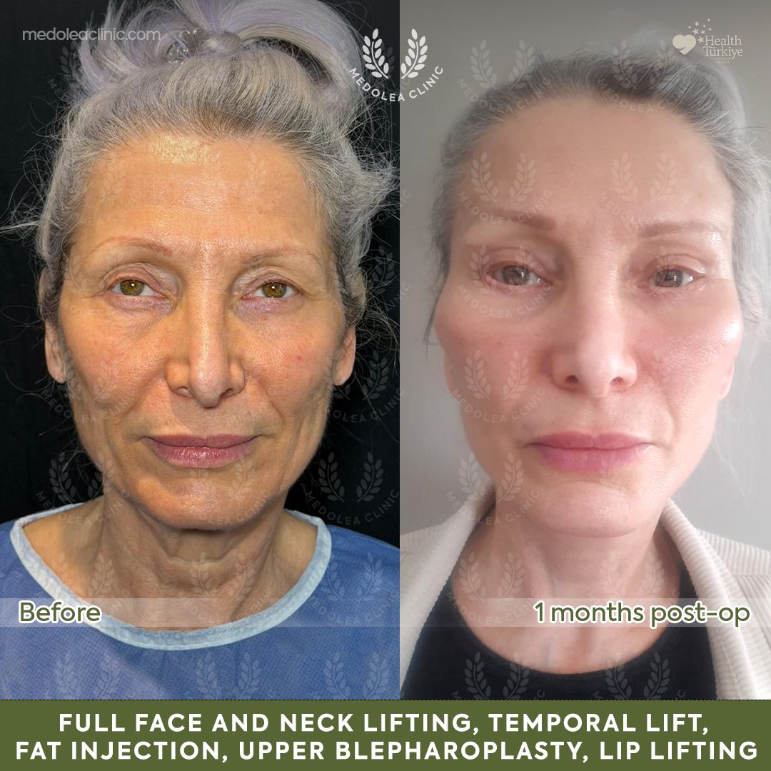 Front view before and one month after full face and neck rejuvenation