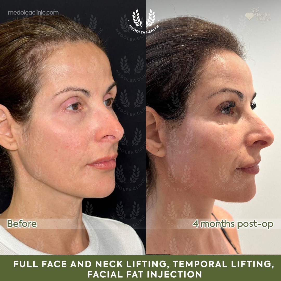Profile view before and four months after full face and neck rejuvenation