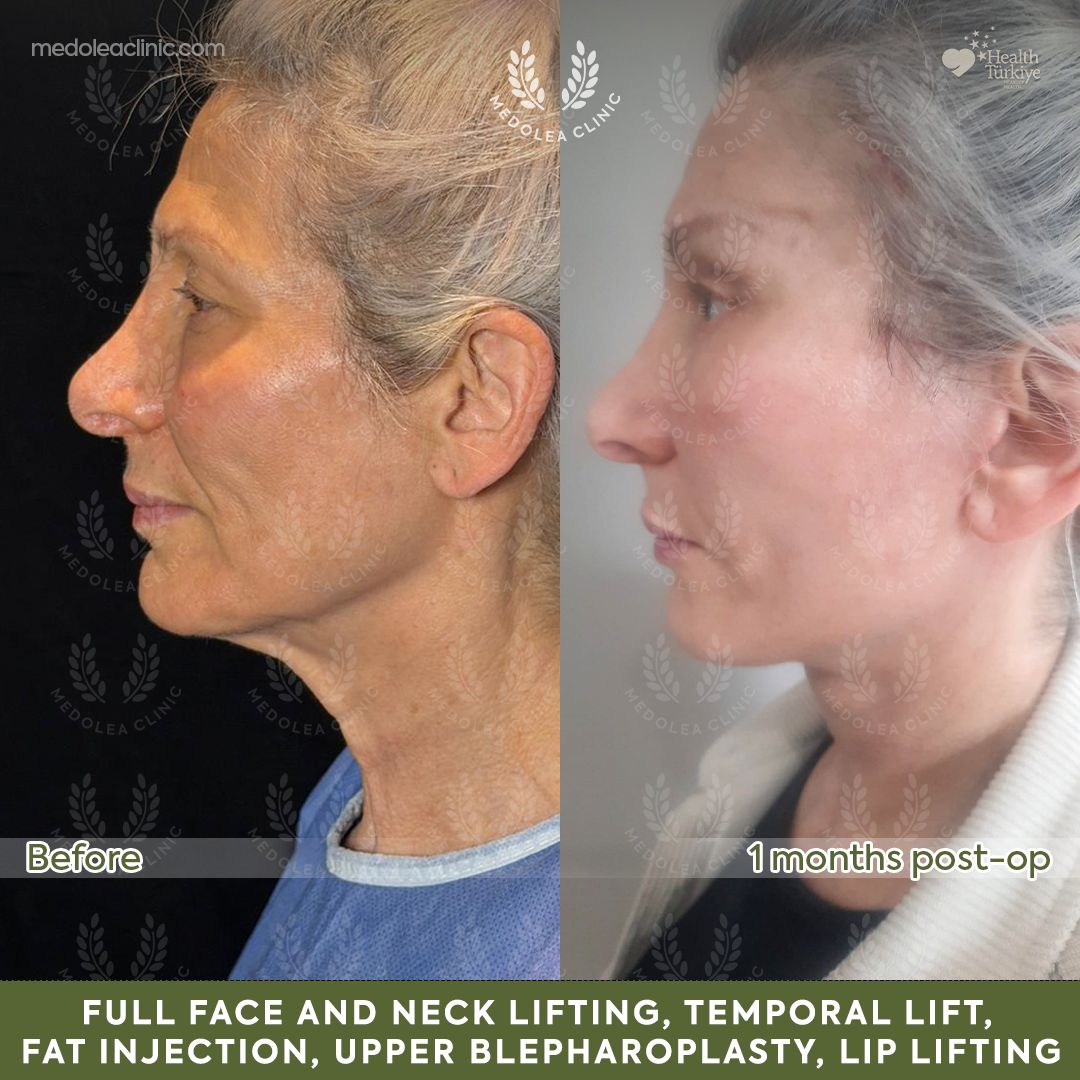 Profile view before and one month after full face and neck rejuvenation