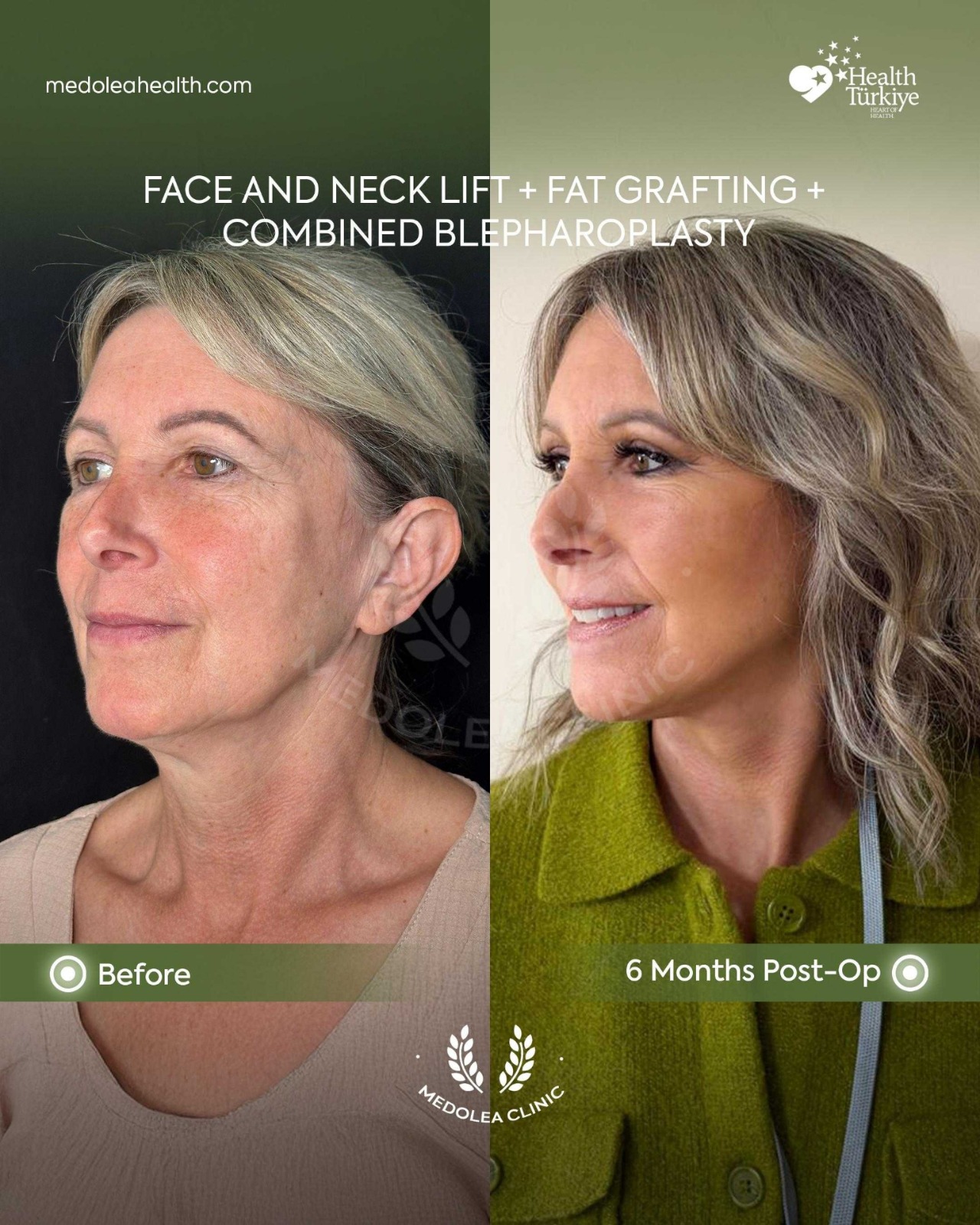 Oblique view before and six months after face, neck and eyelid rejuvenation