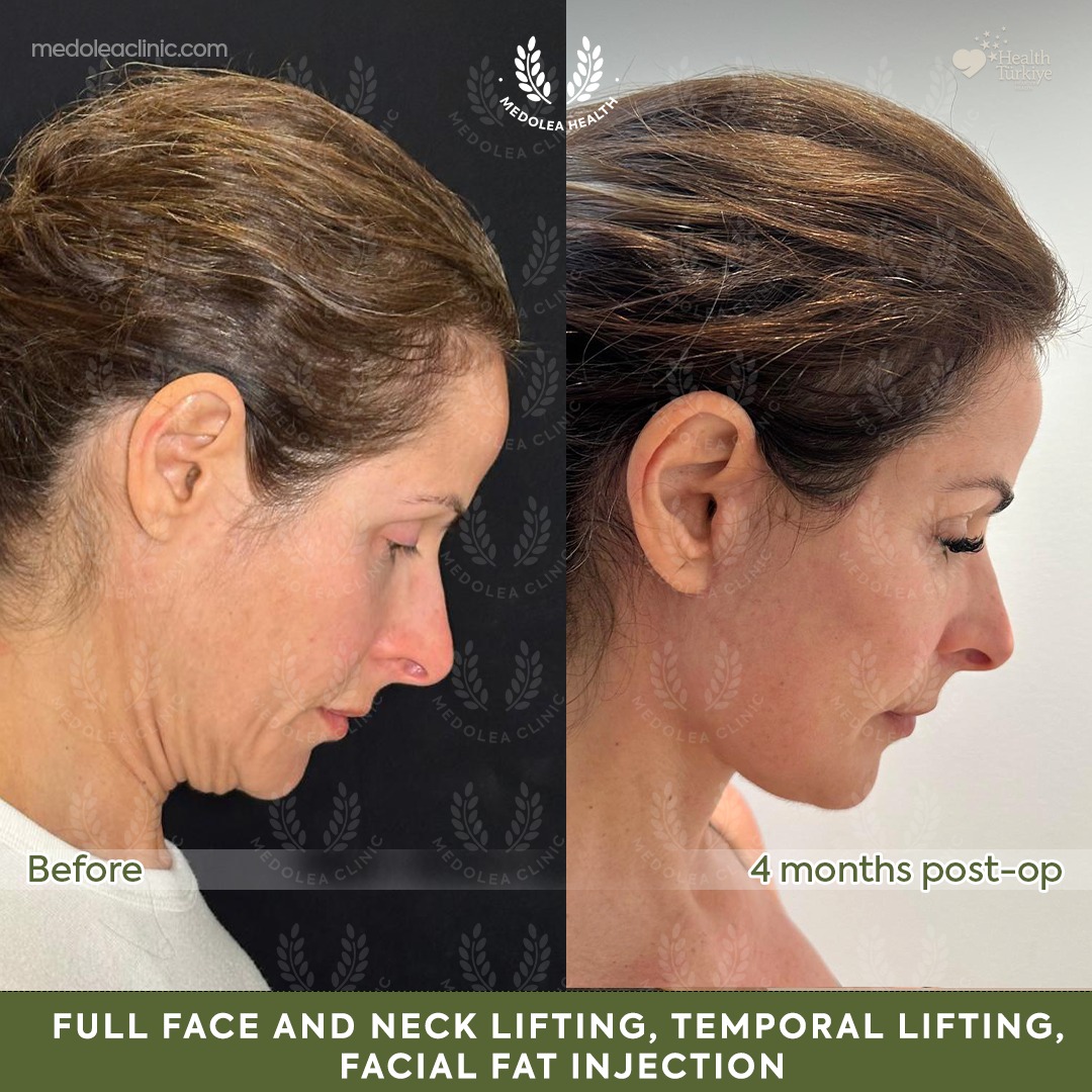 Lower profile view before and four months after full face and neck rejuvenation