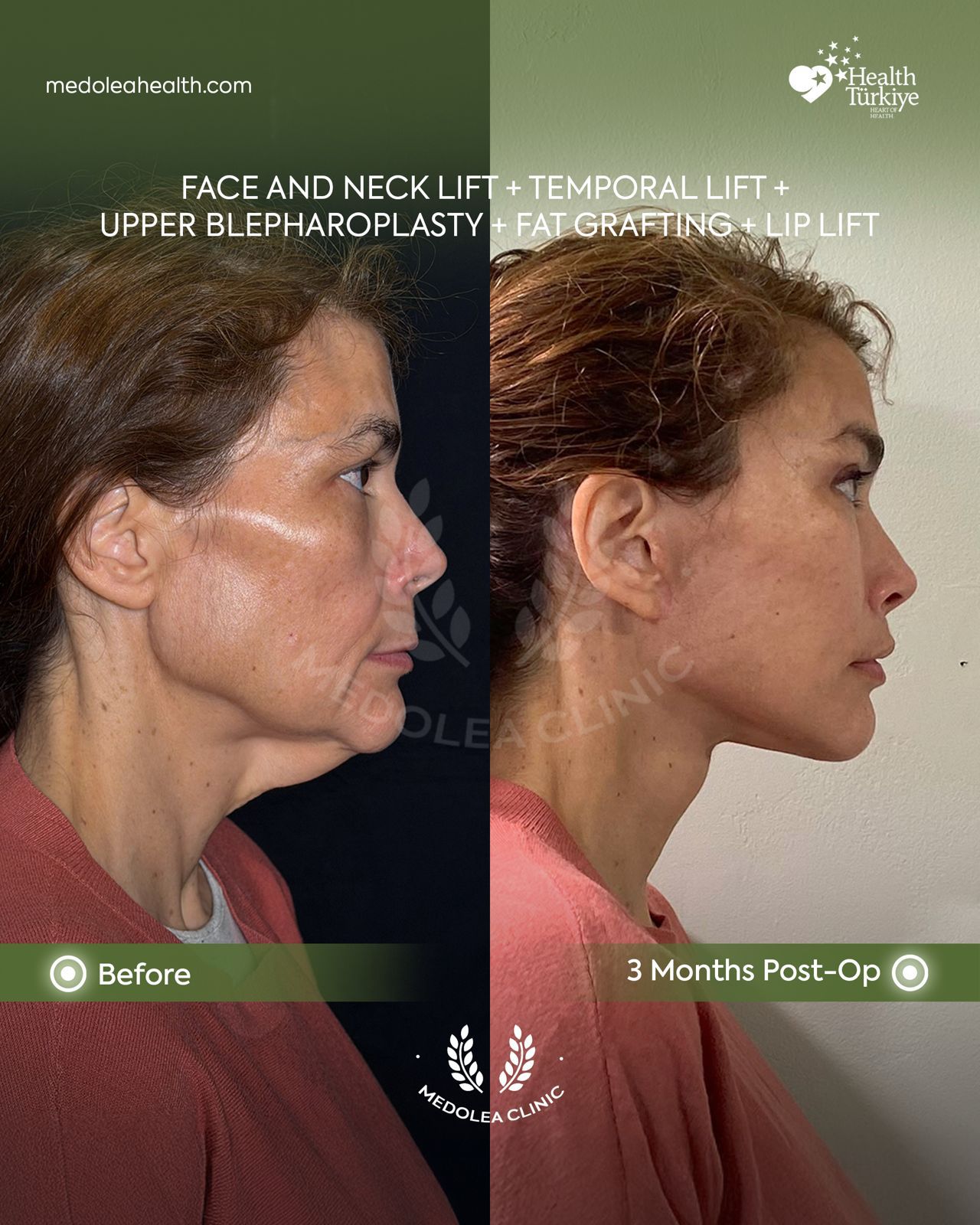 Profile view before and three months after face and neck rejuvenation
