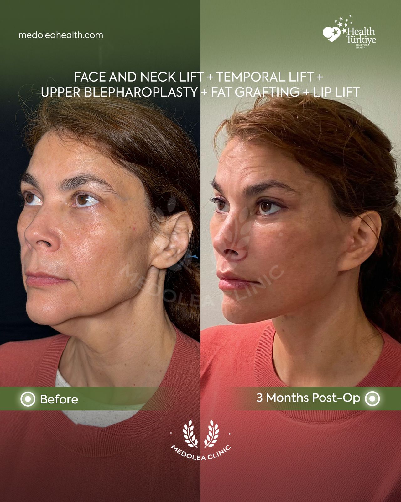 Oblique view before and three months after face and neck rejuvenation