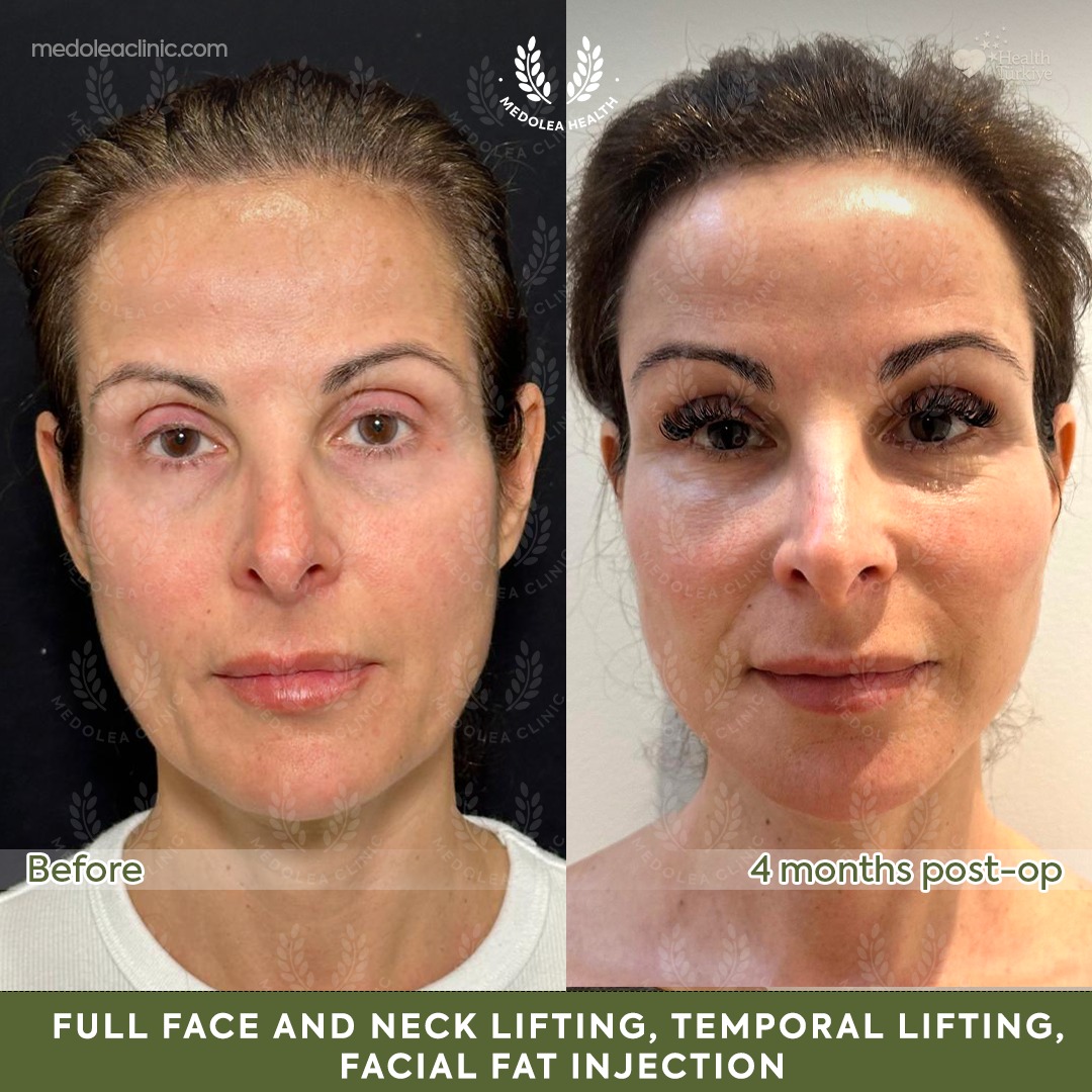 Front view before and four months after full face and neck rejuvenation