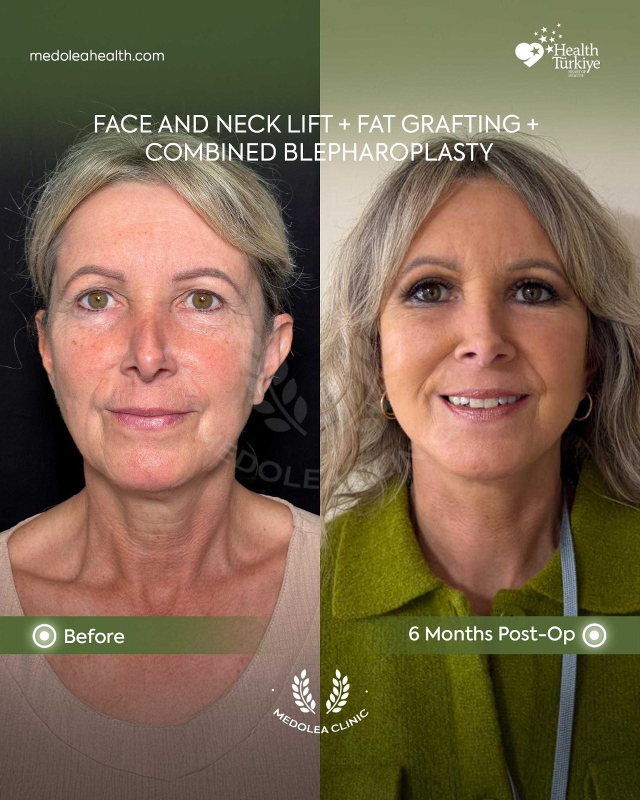 Front view before and six months after face, neck and eyelid rejuvenation